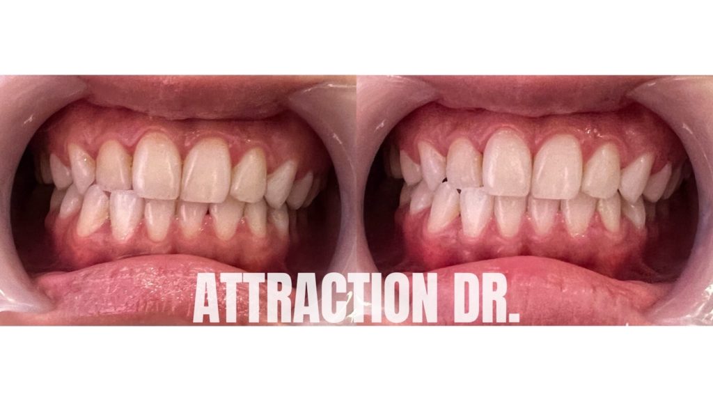 ATTRACTION DR牙齒美白推薦 (18)